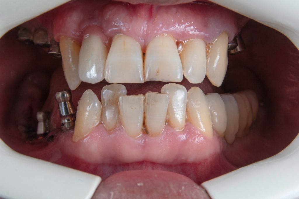 Can i get a lighter denture that still lasts a long time? Can i get help with the cost of dentures?