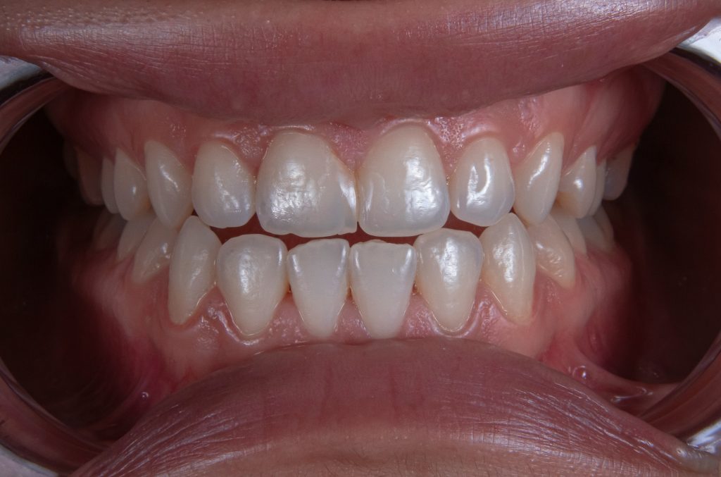 Can i keep some natural teeth and still have a full-looking smile with a partial denture?