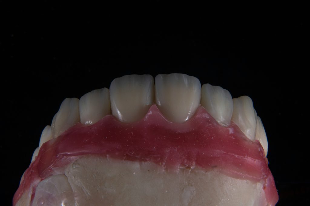 How do i know if i’m eligible for flexible dentures?